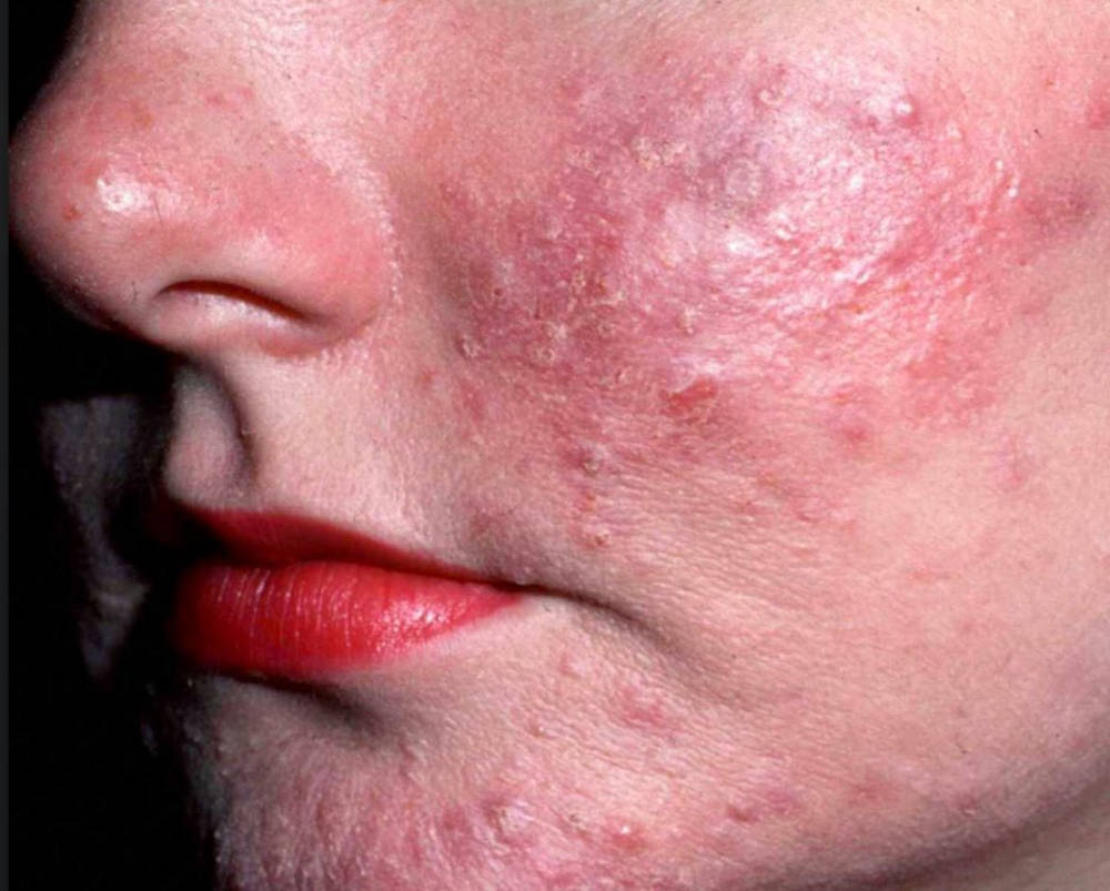 acnee rozacee tratament